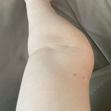 arm_curved {caption: 휘어버린 팔}