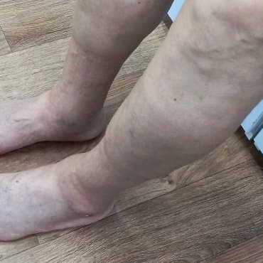 edema_eldery {caption: 종아리까지 부은 발}