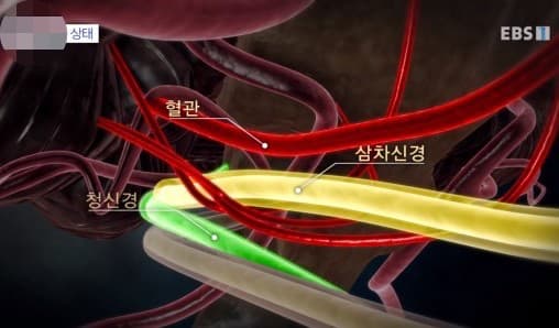 3차-신경통-수술법 {caption: 3차 신경통 수술과정}