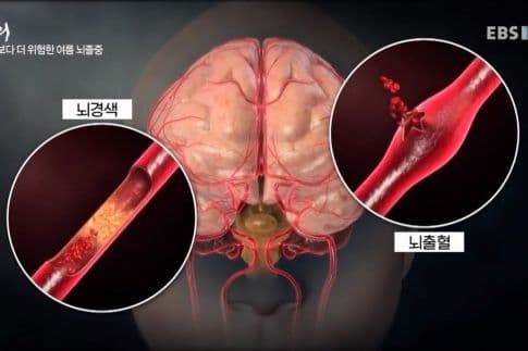stroke_and {caption: 뇌경색과 뇌출혈}
