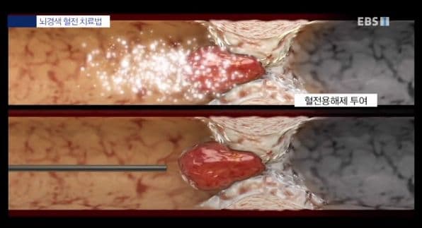 stroke_cure1 {caption: 혈전용해제 투여}