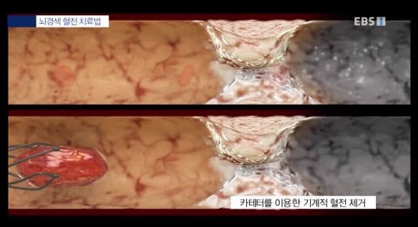 stroke_cure1 {caption: 혈전제거술}